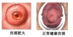 宫颈肥大主要有哪些症状