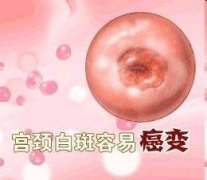 宫颈白斑会给女性带来哪些危害