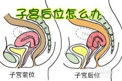 造成子宫后位的原因是什么